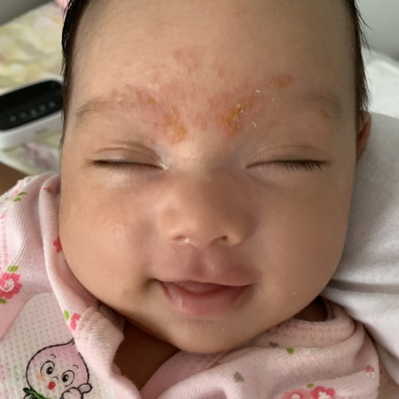 ผื่นบนหน้าทารก