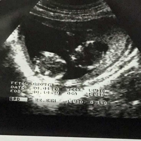 scan 13 weeks kembar