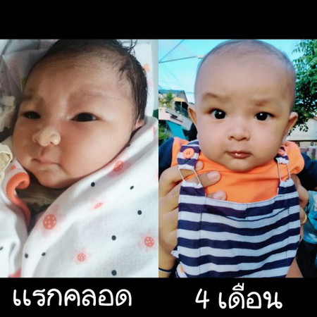 ตอนเเรกคลอดกับตอนปัจจุบัน
