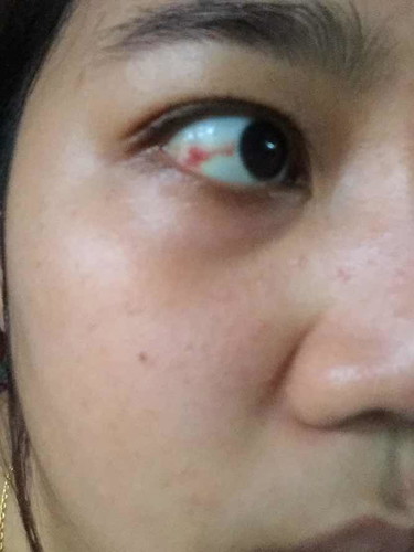มีเลือดขึ้นที่ตา
