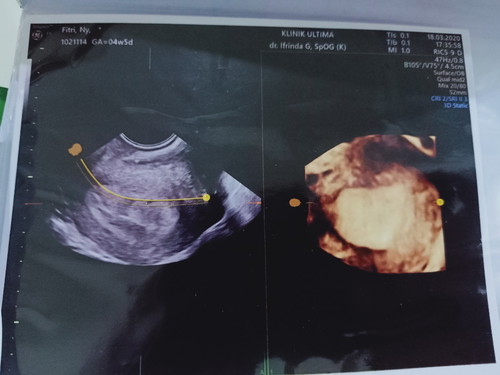 Hasil USG 4minggu