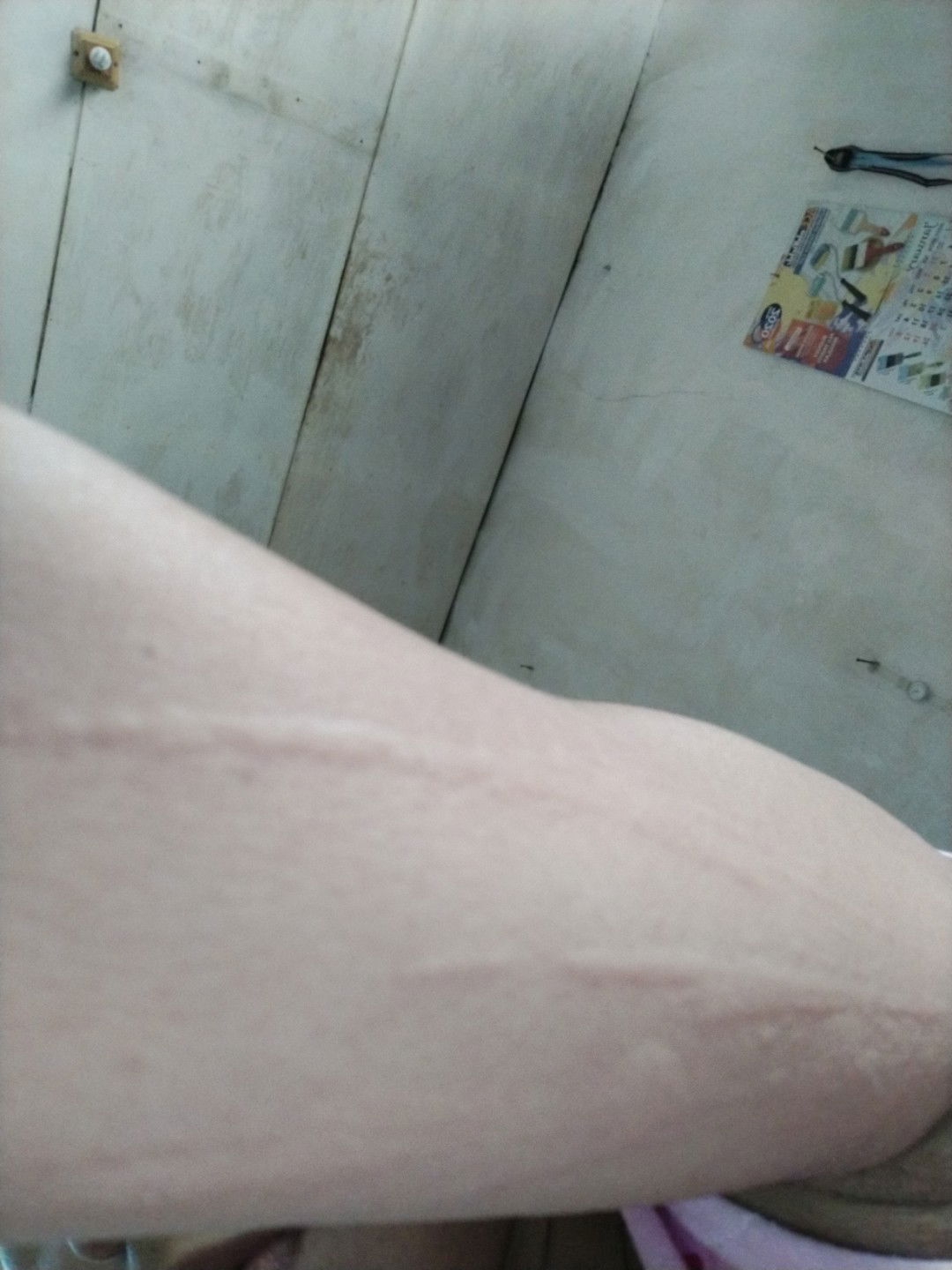 kalo boleh tau ini kenapa y bun saya hamil 5 bulan mengalami gatal2 seperti ini?