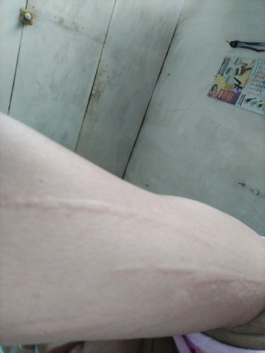 kalo boleh tau ini kenapa y bun saya hamil 5 bulan mengalami gatal2 seperti ini?