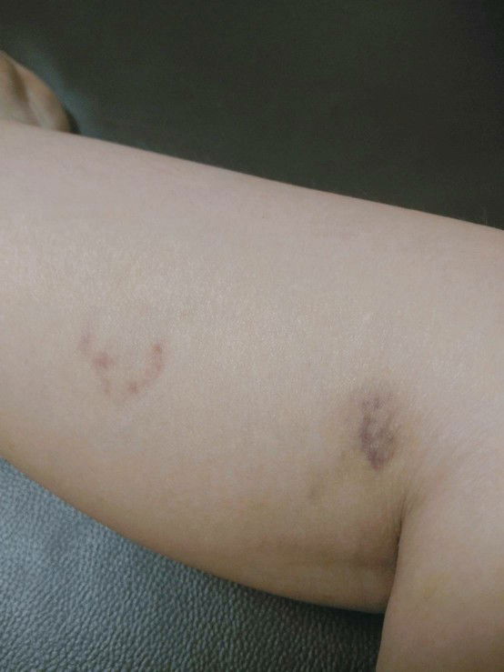 ขาช้ำตลอด เป็นทุกเดือน ที่เดิมๆ