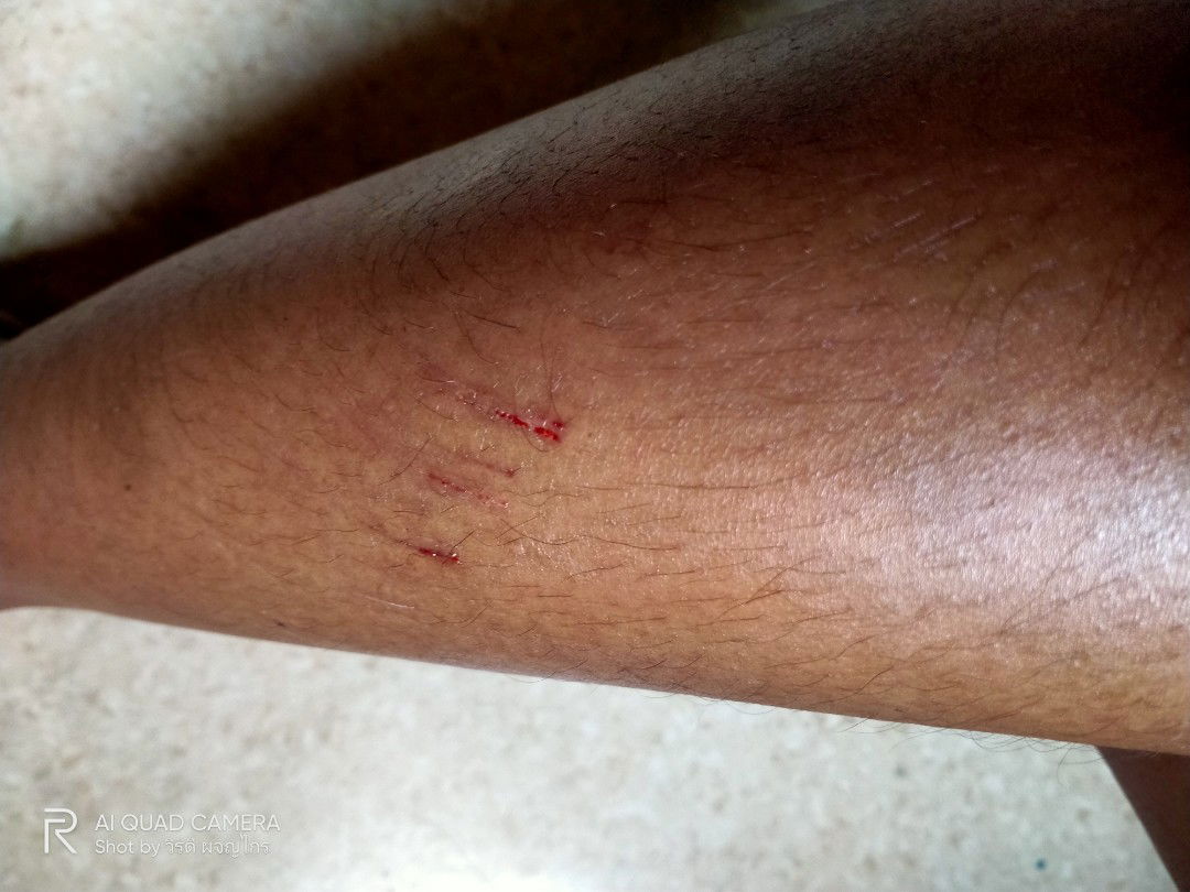 หกล้มเอาท้องลง