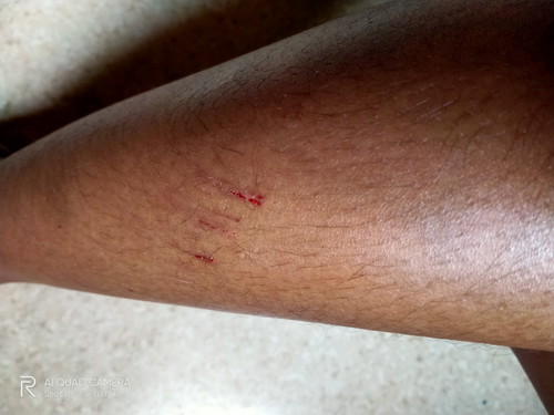 หกล้มเอาท้องลง