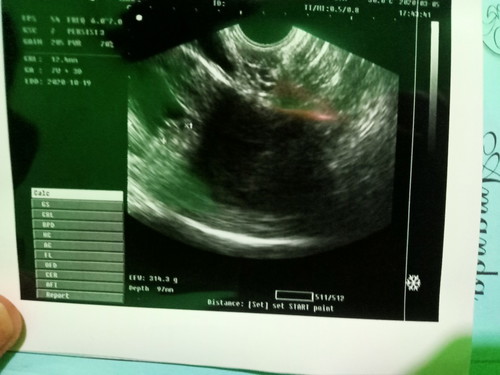 hallo bunda saya lgi hamil 8minggu tp sering ngeflek keluar darah udh coba usg dokte bilang gk keguguran cumn janin nya aja lemah..apa ada bunda2 disini yg ngalamin seperti saya.??