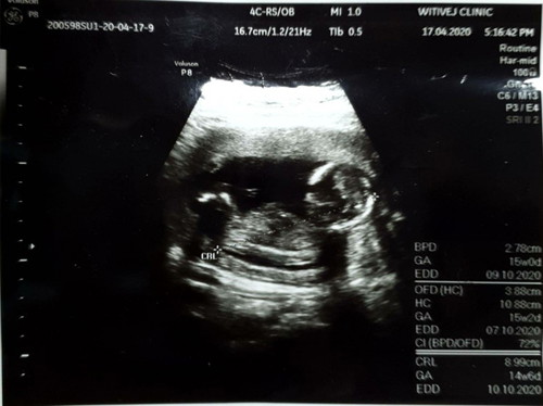 อัลตราซาวนด์ครั้งแรก หมอบอกยังไม่แน่ใจเรื่องเพศค่ะ