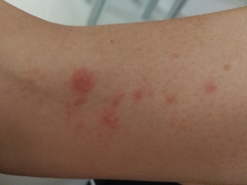 Itchy Rashes