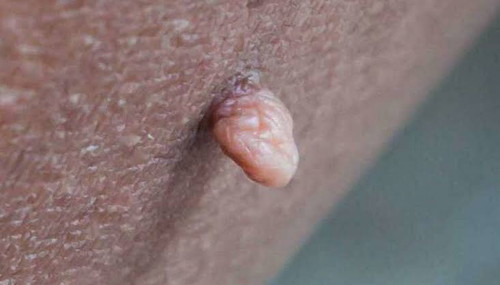 skin tags