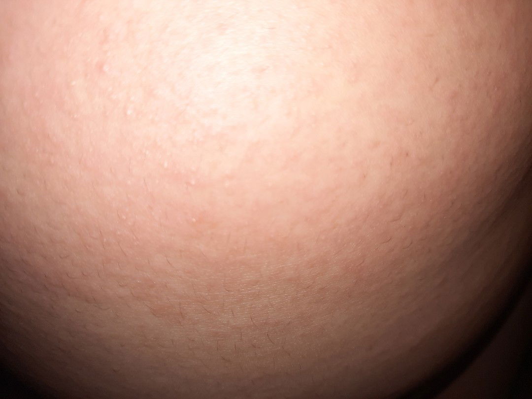 Perut gatel bentol kecil-kecil seperti biang keringet