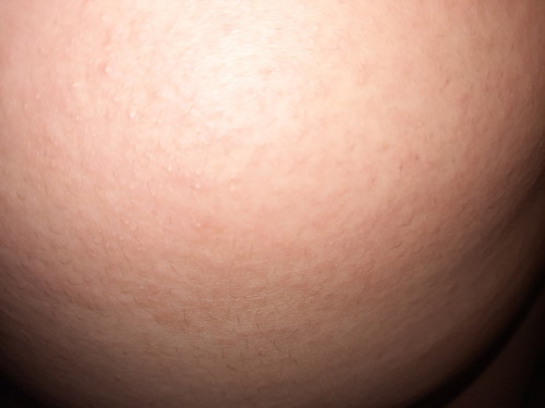 Perut gatel bentol kecil-kecil seperti biang keringet