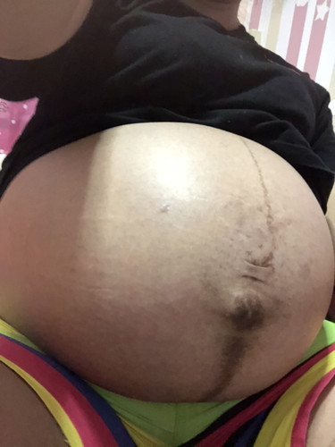 มีใครท้องดำเป็นเส้นๆล่างสะดือไหมคะ