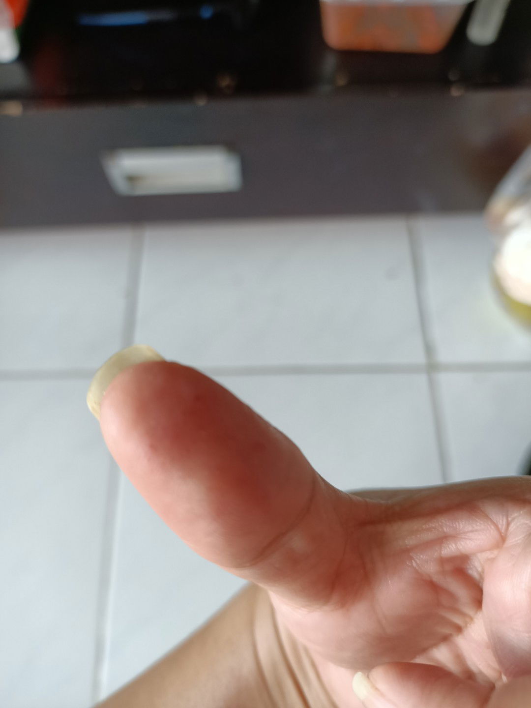 Hi bun, Ada yg pernah ngalamin bintil bintil kecil seperti berair ga dijari? Kira2 ini penyebabnya apa ya? Diobatinnya bgmn utk bumil?