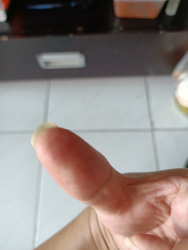 Hi bun, Ada yg pernah ngalamin bintil bintil kecil seperti berair ga dijari? Kira2 ini penyebabnya apa ya? Diobatinnya bgmn utk bumil?