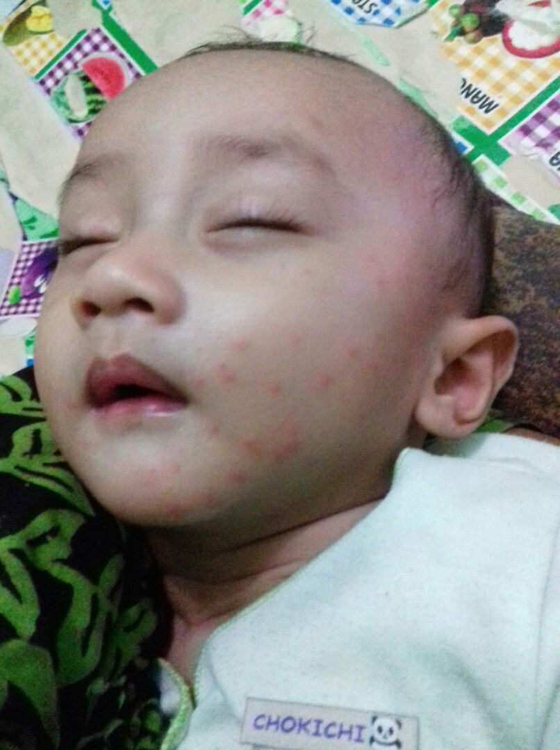 bintik merah di seluruh tubuh