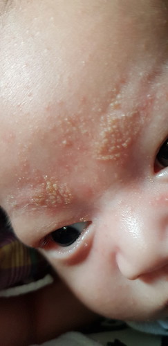 Rashes on LO's face