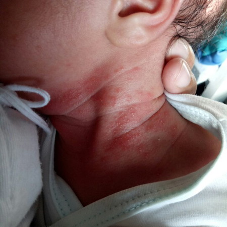 Rashes