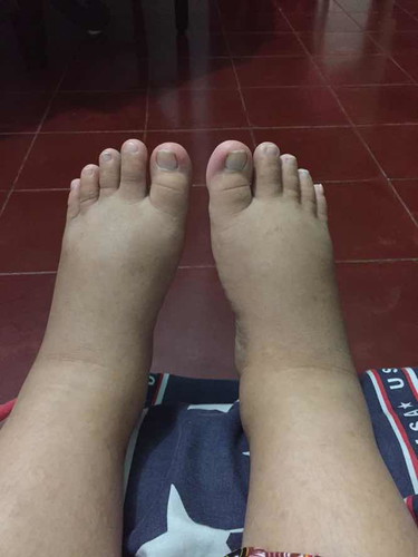 Kaki bengkak