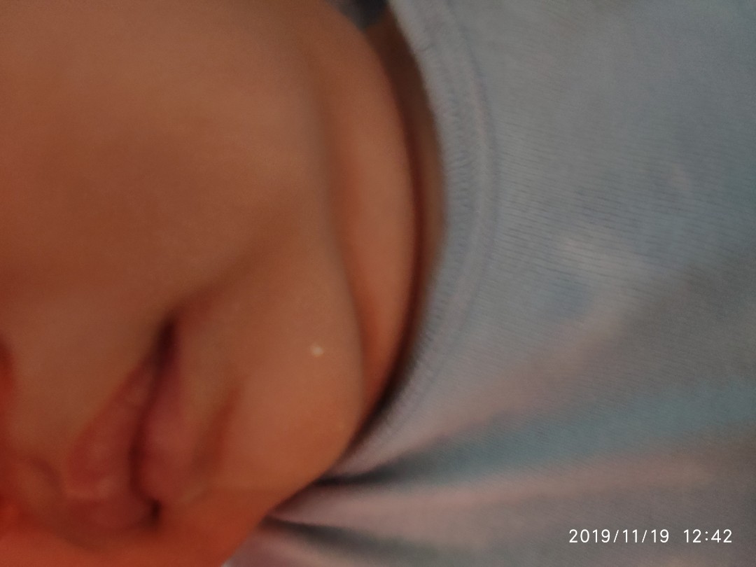 Jerawat bayi