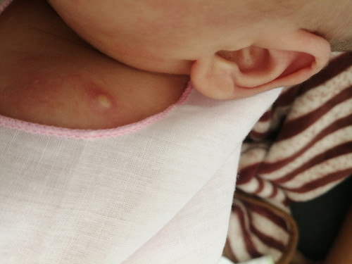 รอยฉีดยาแรกเกิดแบบนี้ปกติไหมคะ