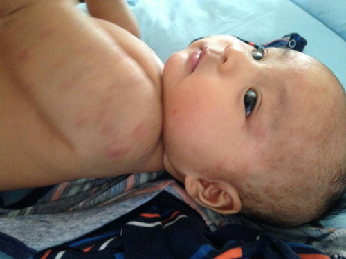 ลูกเป็นผื่น รักษาได้ 2 เดือนแล้วไม่หายสักทีค่ะ