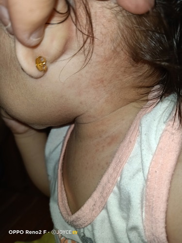 Rashes on my baby's forehead up to her neck