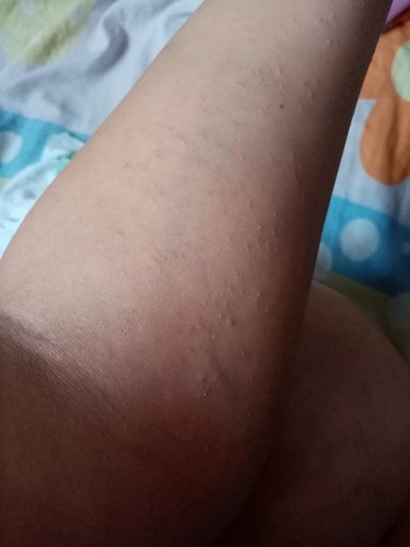 pregnancy itchiness