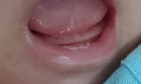 nấm miệng
