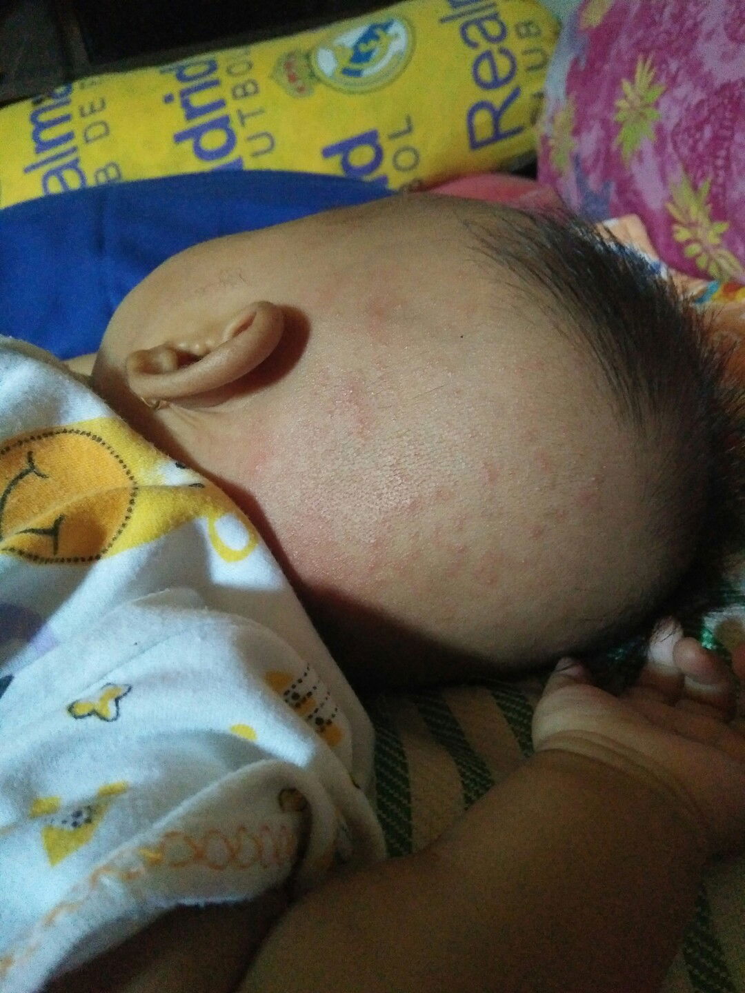 merah merah di kepala baby