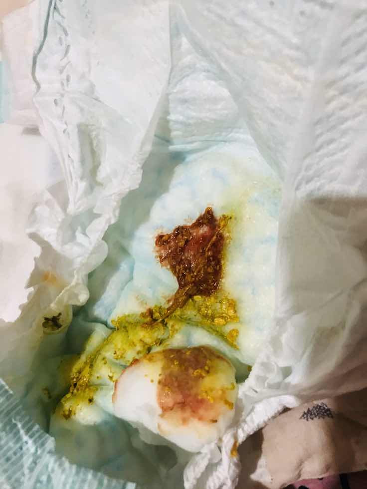 Blood in Stool (Newborn one month old)