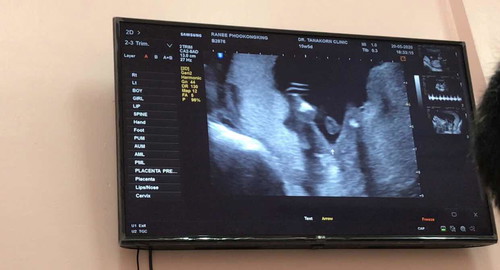 มีใครที่หมอบอก80% แล้วไม่ใช่ไหมคะ