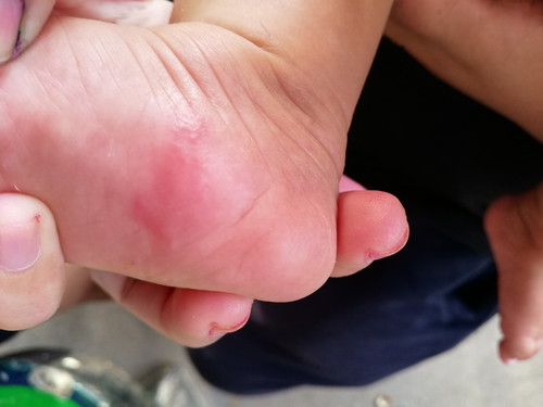 เป็นตุ่มแดงใสๆเกิดจากสาเหตุใด