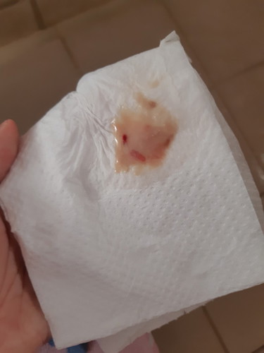 Mucus with blood discharge