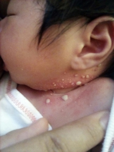 Baby allergy
