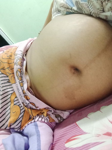 เจ็บหนังท้อง