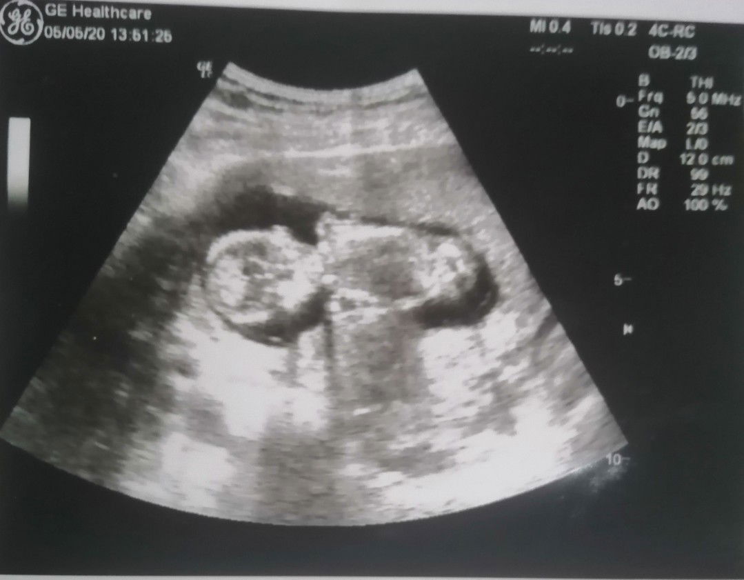 อัลตราซาวด์