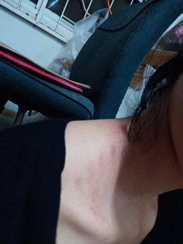 ท้อง3เดือนเป็นงูสวัด