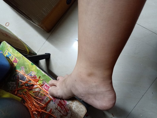 เท้าบวม