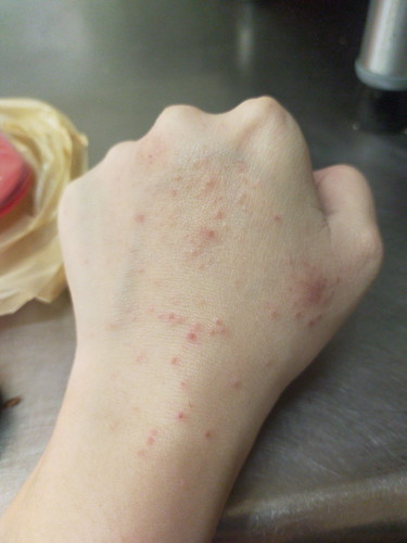 มีตุ่มใสๆขึ้น