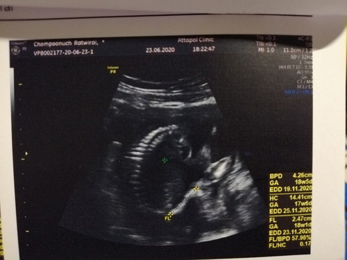 อายุครรภ์ยึดตามใบหมอซาวใช่ไหมคะ