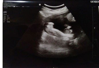 ultrasound blurrrrred gender