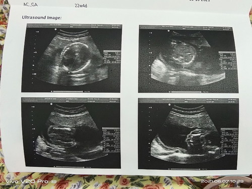 23week ซาวด์ดูเพศร้อนนน 🥰