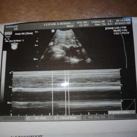 1st Sonogram