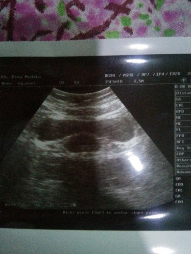hasil tespack negatif usg positif