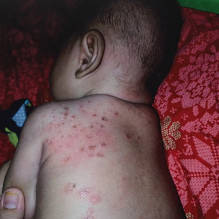 cacar air pada bayi 2 bulan