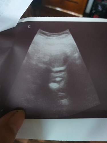 ultrasound of 4weeks