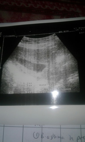 jantung baby bila scan xada