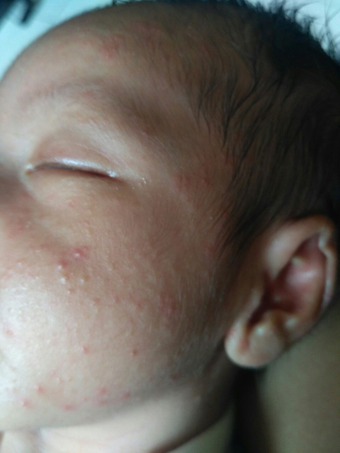 bintik-bintik merah pada wajah bayi