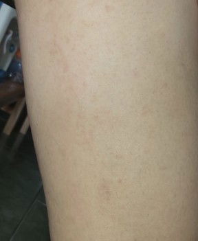 Gatal2 saat awal kehamilan